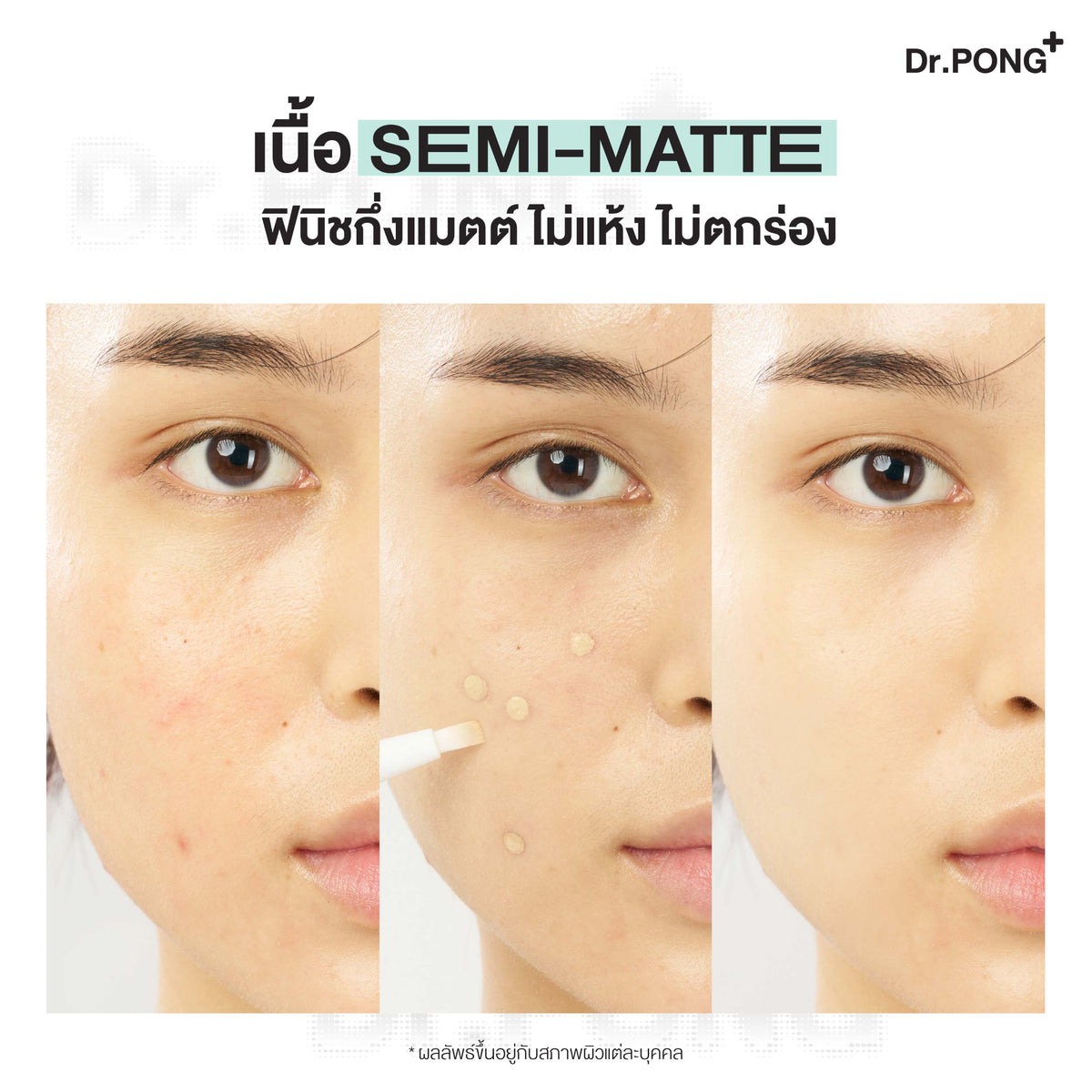 Dr.PONG ACNE ACE AIRY BRUSH CONCEALER คอนซีลเลอร์แต้มสิว กลบรอยสิวเนียนกริบ ไม่อุดตัน มีผลทดสอบงานวิจัย