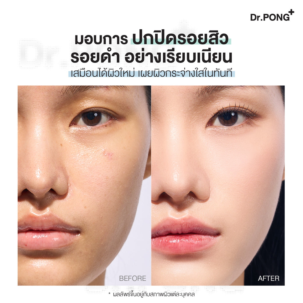 Dr.PONG ACNE ACE LONGWEAR CUSHION คุชชั่นลดสิว คุมมัน ติดทน กันน้ำ ไม่หลุดง่าย